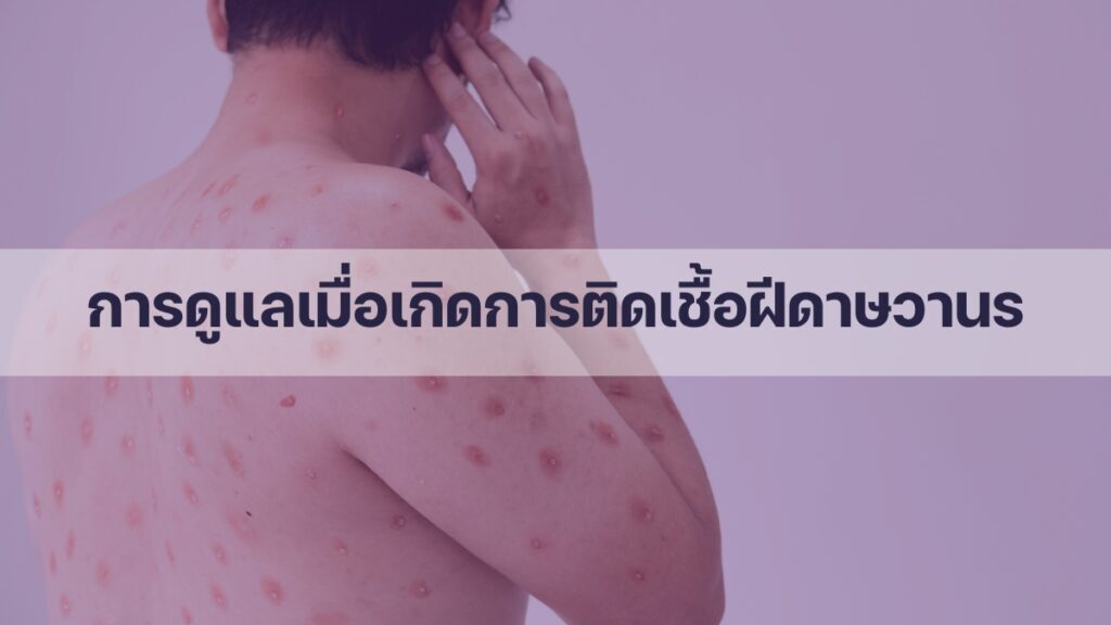 การดูแลเมื่อเกิดการติด เชื้อฝีดาษวานร