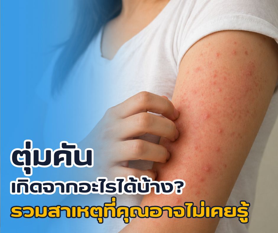 ตุ่มคันเกิดจากอะไรได้บ้าง? รวมสาเหตุที่คุณอาจไม่เคยรู้